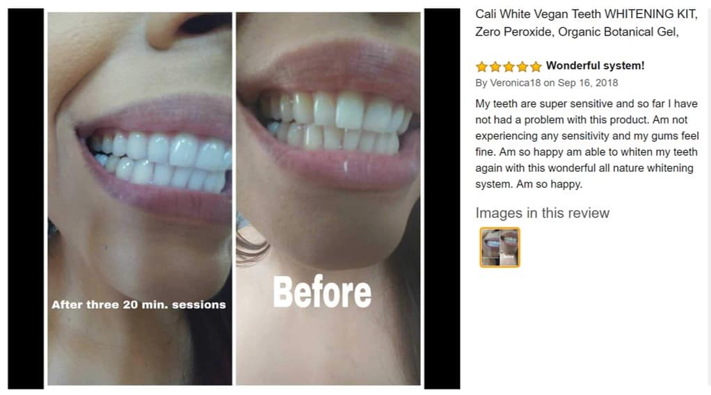 ebay teeth whitening kits review